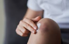 5 ways to heal bruises to heal quickly
